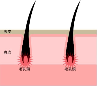 従来の脱毛器